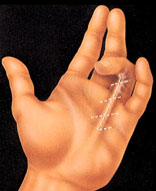 hand_surgery-4