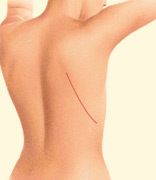 breast_reconstruction-3