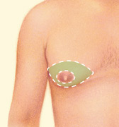 gynecomastia-1