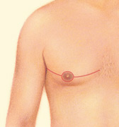 gynecomastia-1