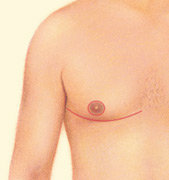 gynecomastia-3