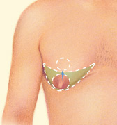 gynecomastia-2