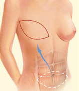 breast_reconstruction-1